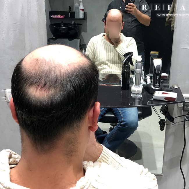 רפאל - פתרונות שיער לגברים