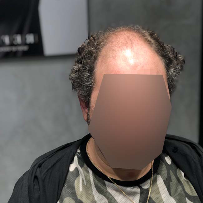 רפאל - פתרונות שיער לגברים