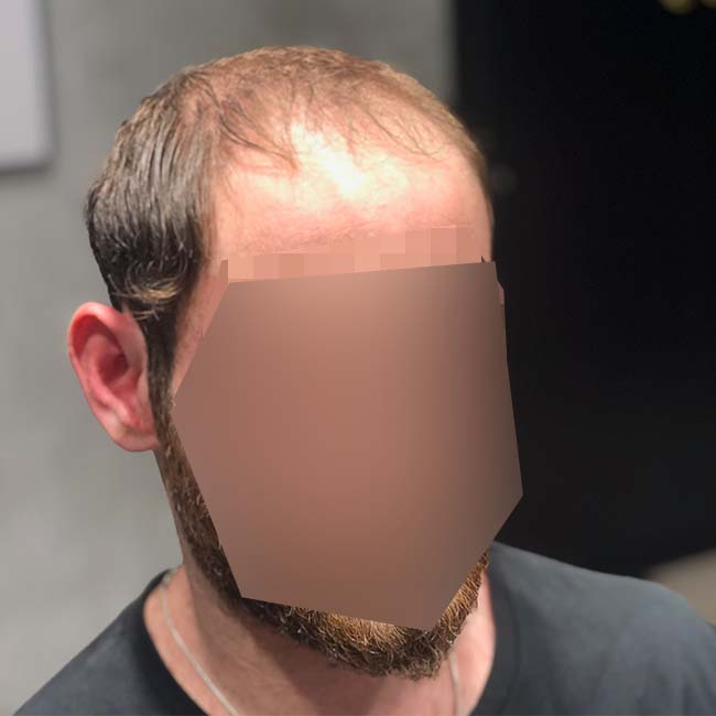 רפאל - פתרונות שיער לגברים